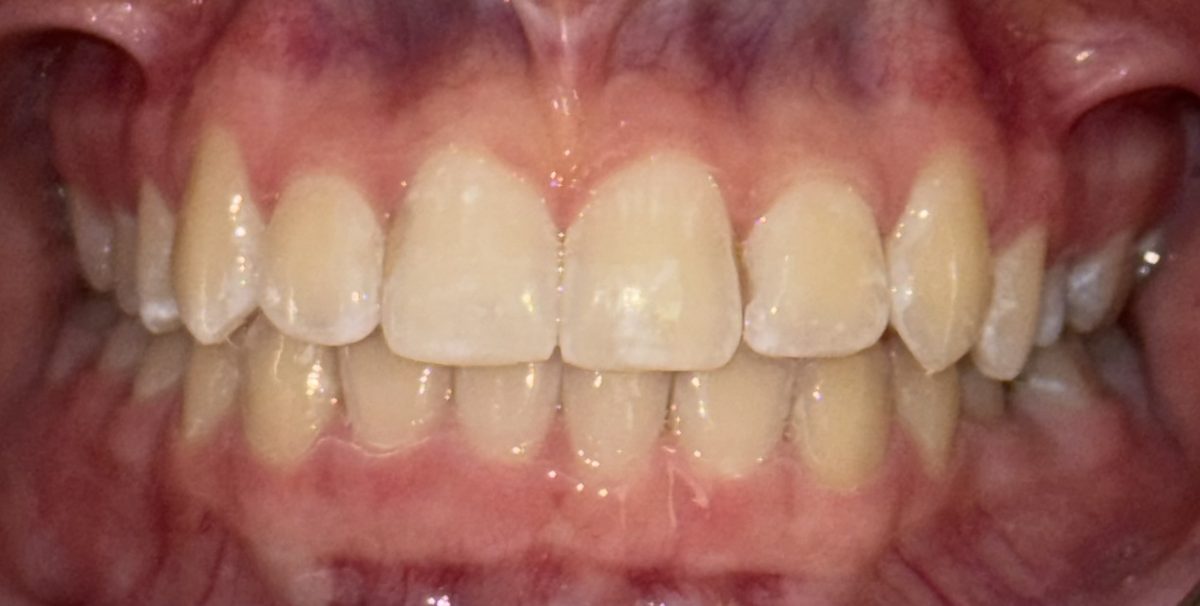 The same patient's upper front teeth after treatment, evenly aligned