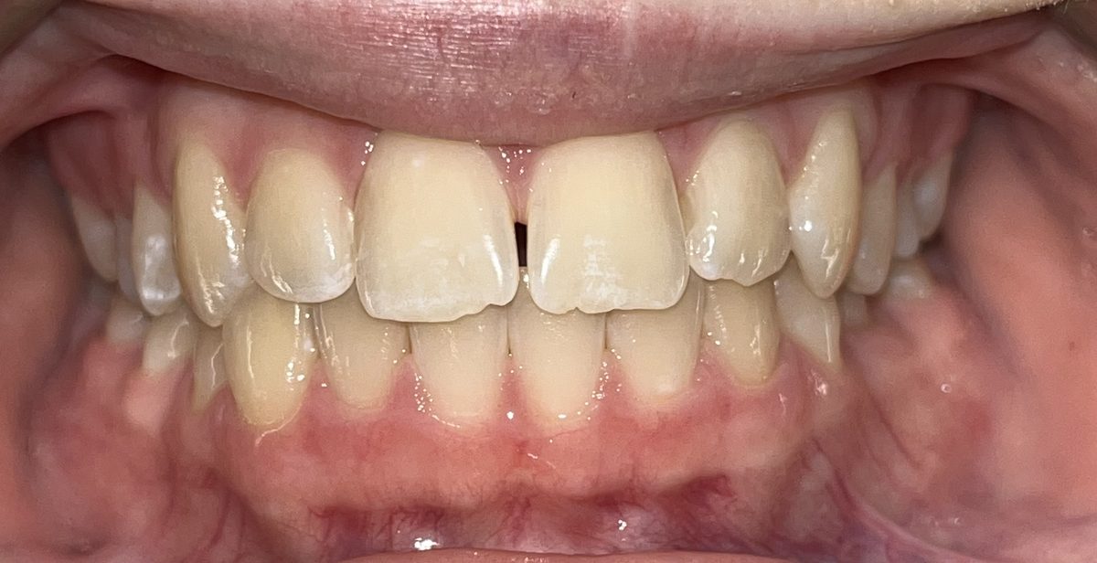 A patient's upper front teeth before orthodontic treatment