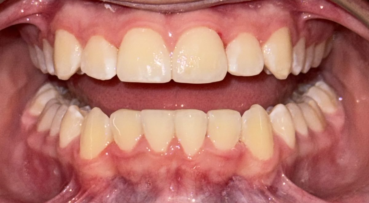 The same patient's upper and lower teeth after treatment, evenly aligned