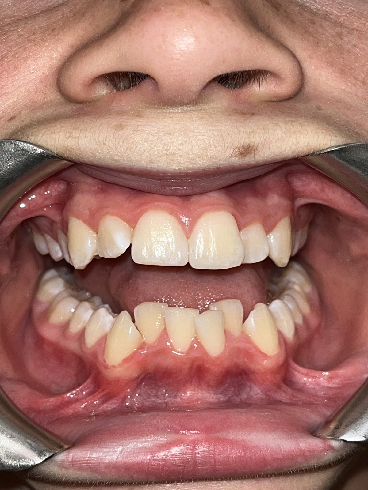 A patient's upper and lower teeth before orthodontic treatment, crowded and uneven