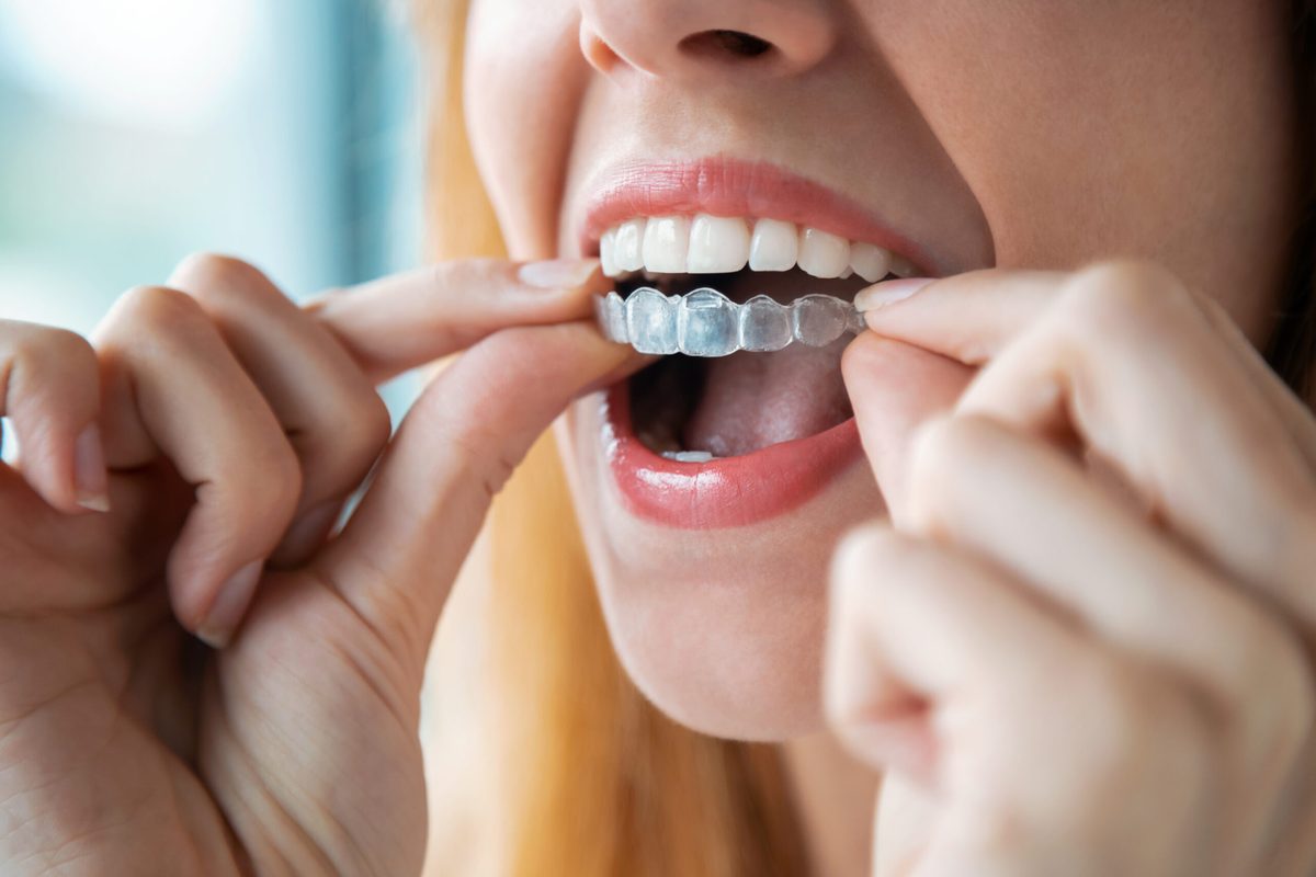 Patient placing a clear aligner tray over their teeth