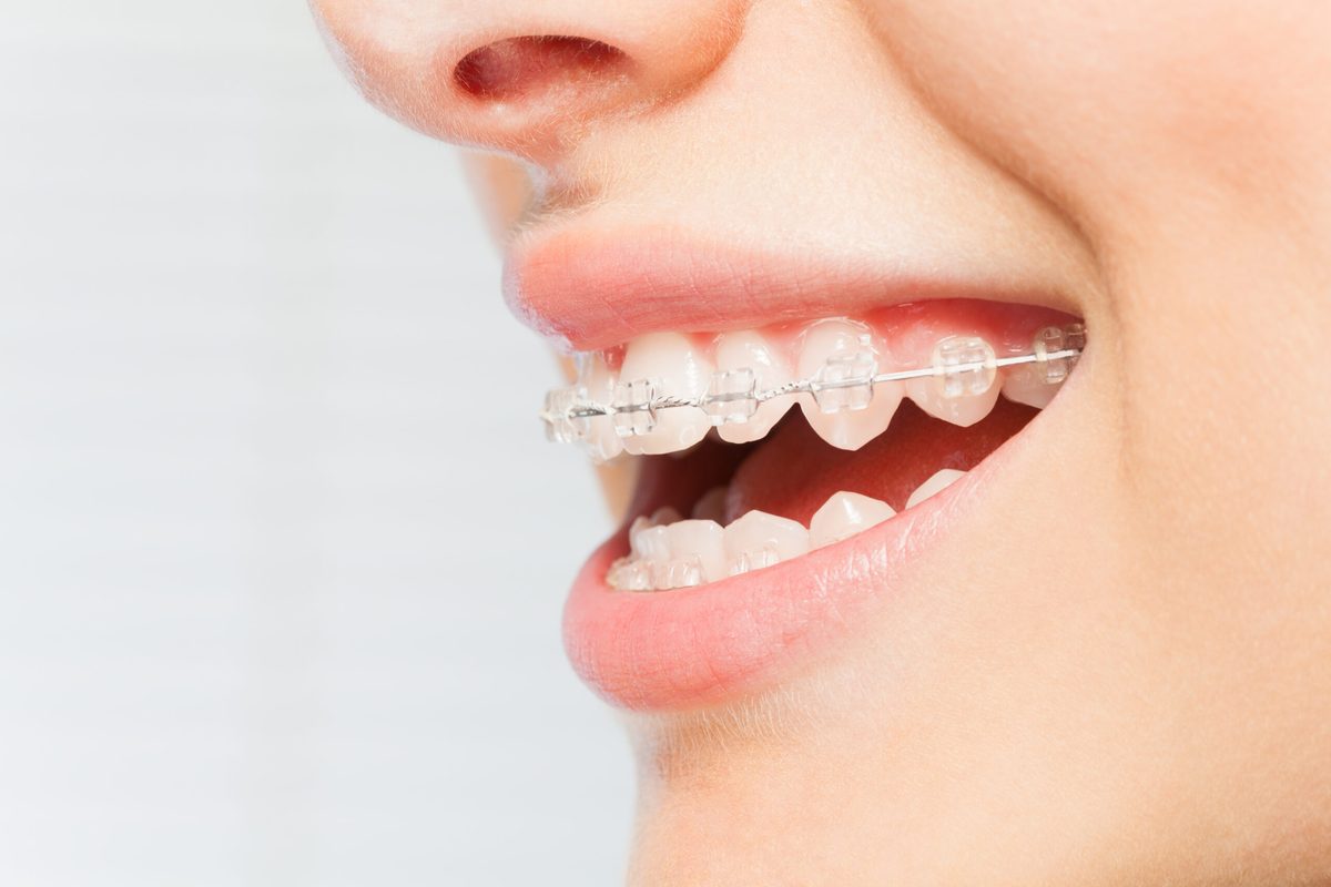 Close-up of a smile with tooth-coloured clear braces