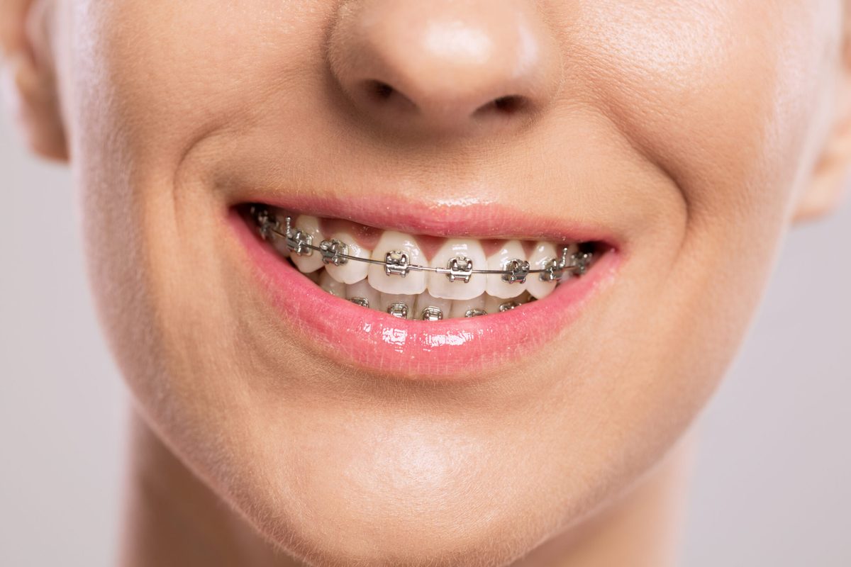 Close-up of a smile with metal braces