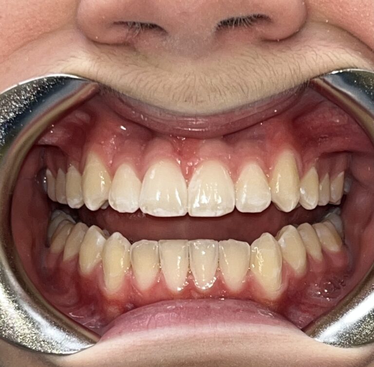 Patient 1 smile after orthodontic treatment