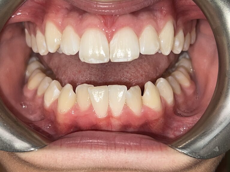 Patient 1 smile before orthodontic treatment