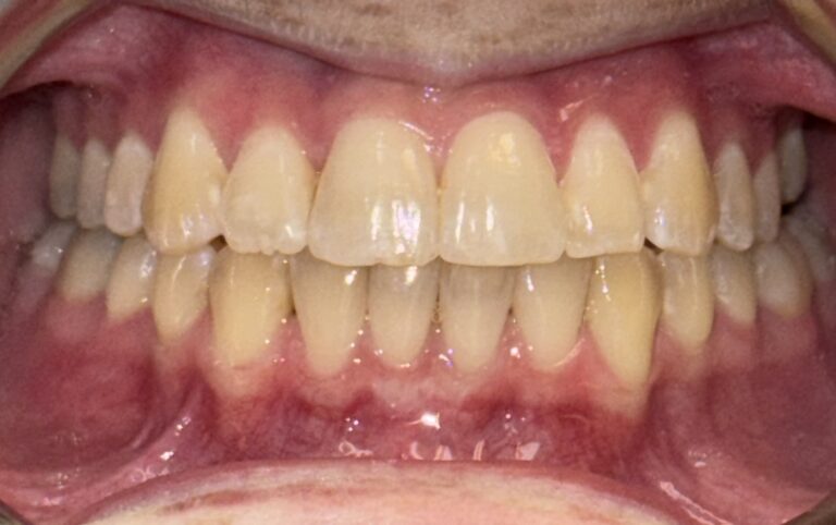 Patient 2 smile after orthodontic treatment