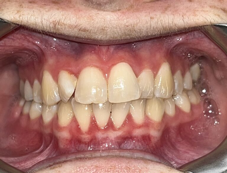 Patient 2 smile before orthodontic treatment