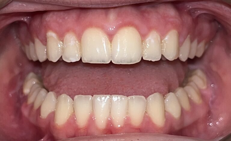 Patient 3 smile after orthodontic treatment