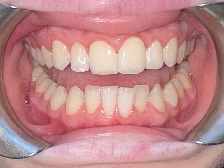 Patient 3 smile before orthodontic treatment