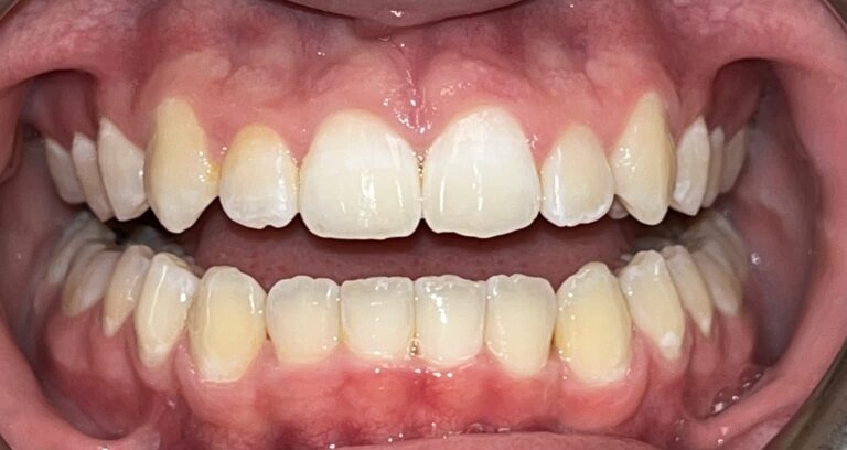 Patient 4 smile after orthodontic treatment