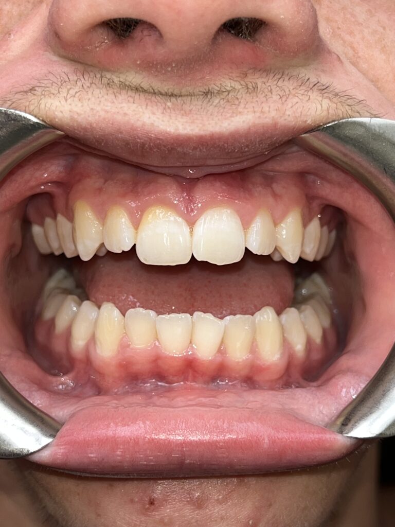 Patient 4 smile before orthodontic treatment