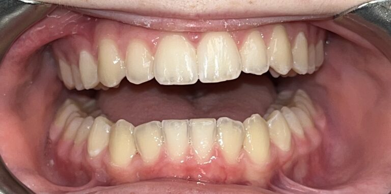 Patient 5 smile after orthodontic treatment