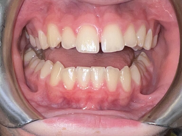 Patient 5 smile before orthodontic treatment