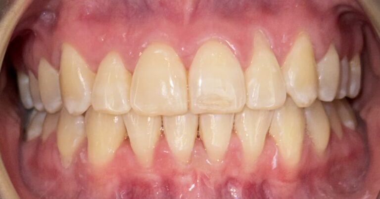 Patient 6 smile after orthodontic treatment