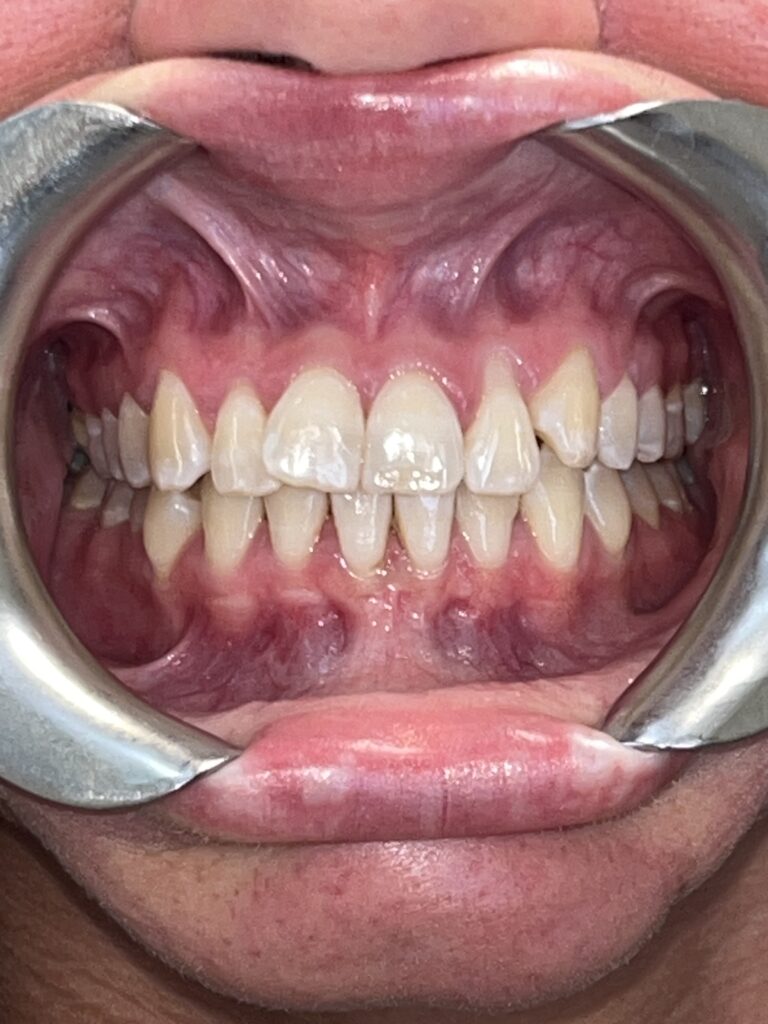 Patient 6 smile before orthodontic treatment