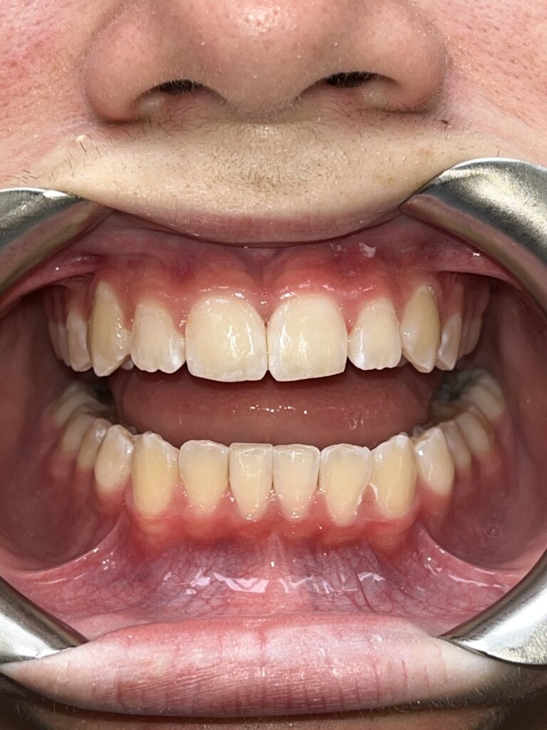 Patient 9 smile after orthodontic treatment
