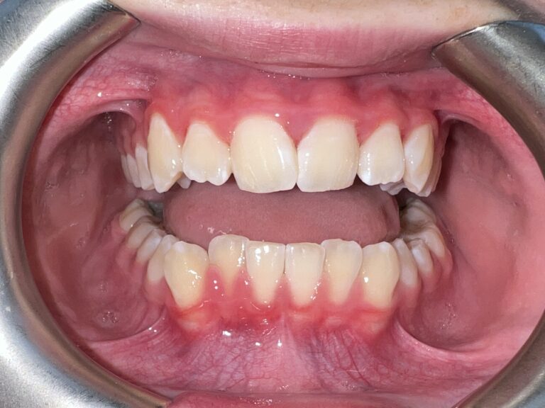 Patient 9 smile before orthodontic treatment