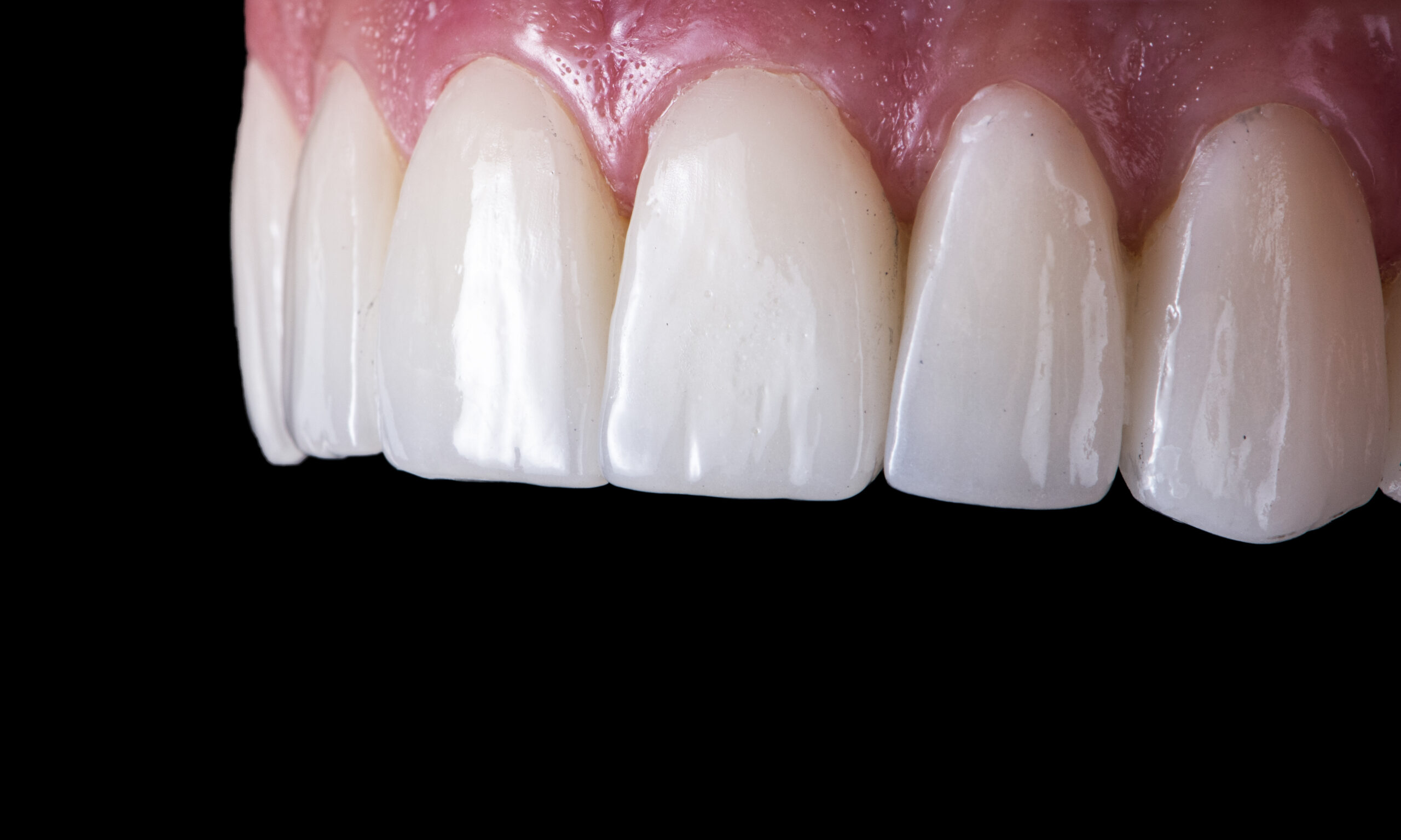 Custom dental veneers