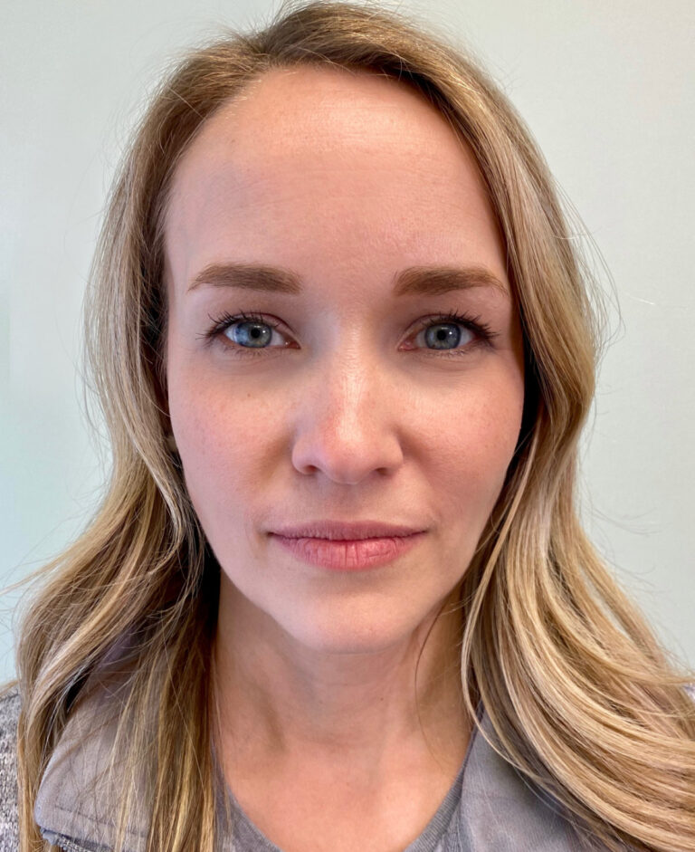 Example smile photo angle 2 for a virtual consultation