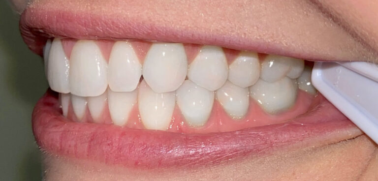 Example smile photo angle 4 for a virtual consultation