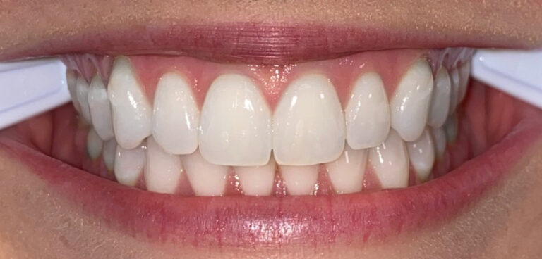 Example smile photo angle 5 for a virtual consultation