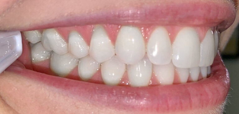 Example smile photo angle 6 for a virtual consultation