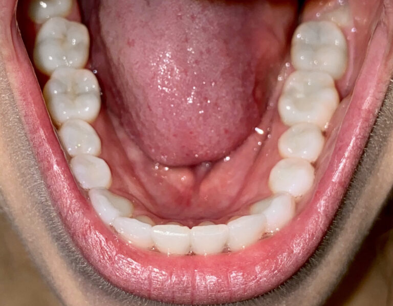 Example smile photo angle 7 for a virtual consultation