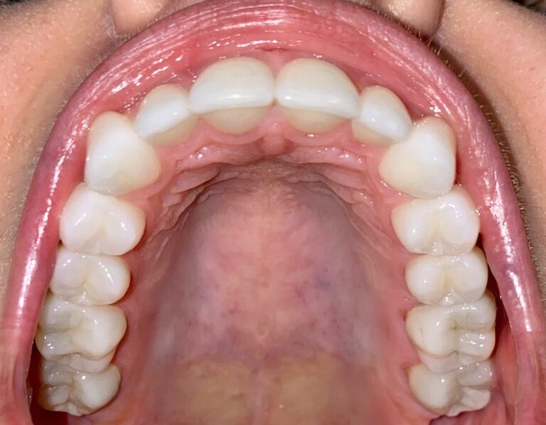 Example smile photo angle 8 for a virtual consultation